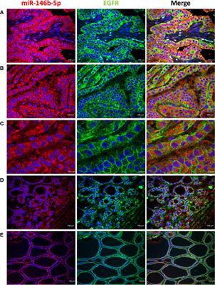 A new paradigm for epidermal growth factor receptor expression exists in PTC and NIFTP regulated by microRNAs